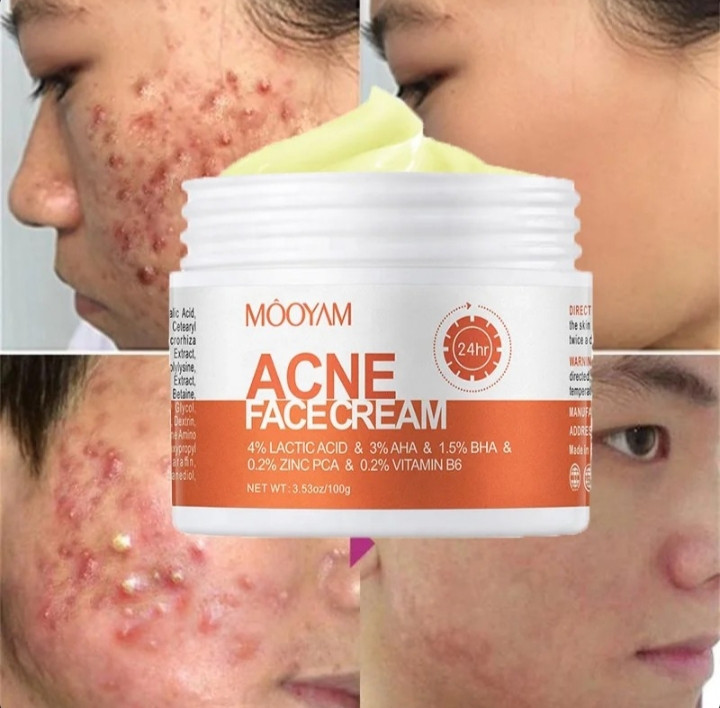 ضد جوش و آکنه مویام اصلی