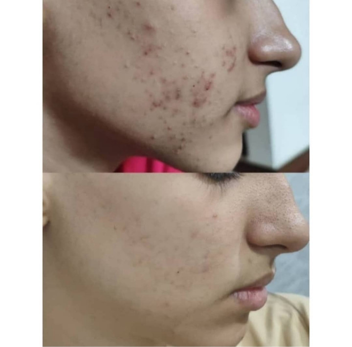 ضد جای جوش