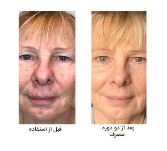 روشن کننده و ضد لک و ضد پیری زودرس