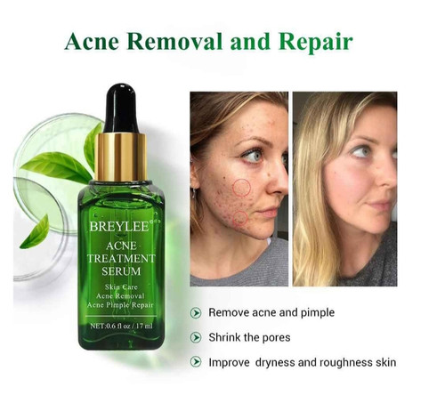 حذف آکنه و جوش صورت بدون روغن و چربی آبرسان و مرطوب کننده